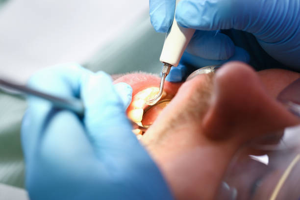 Best Emergency Dentist for Lost Fillings or Crowns in Forest City, IA